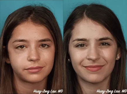 Facial Bone Fracture Treatment