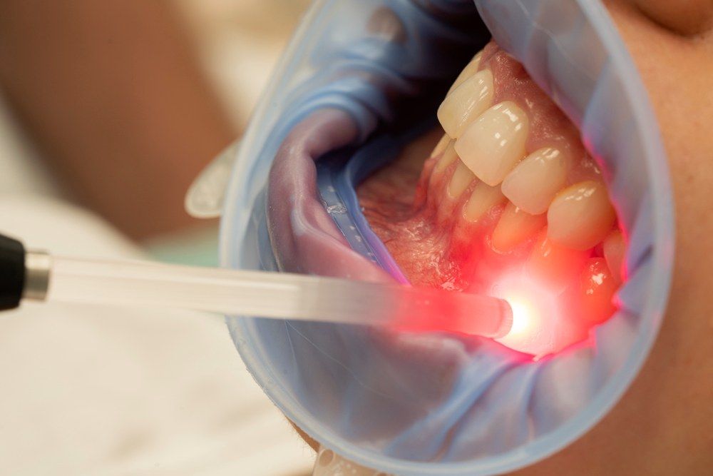 Laser Soft Tissue Procedure