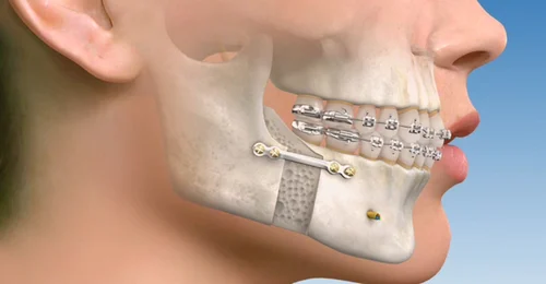 best Corrective jaw surgeries in pune, Laxmi road, Camp