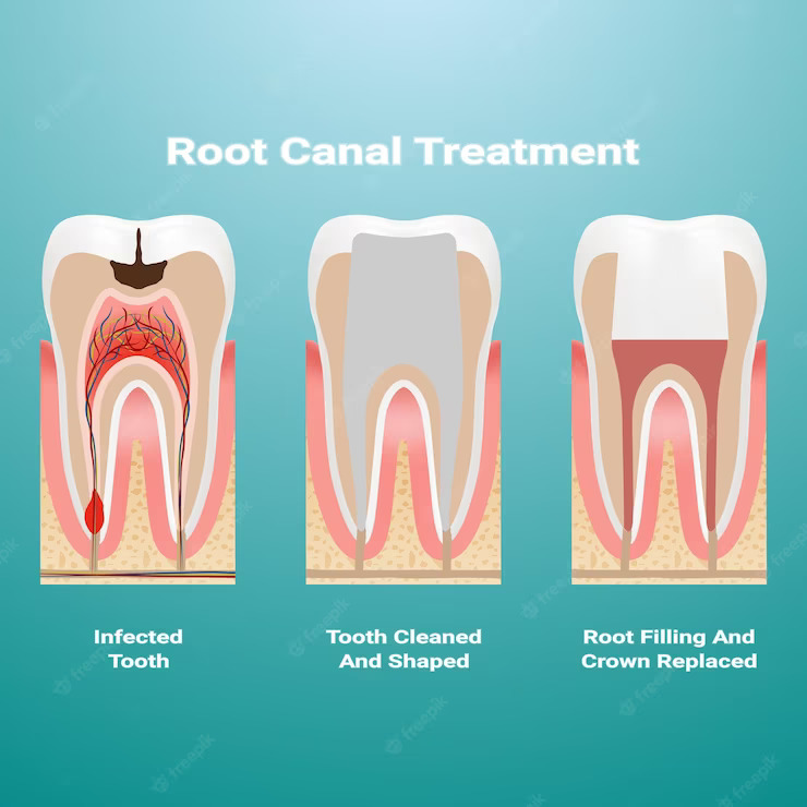 best Root canal in pune, Laxmi road, Camp