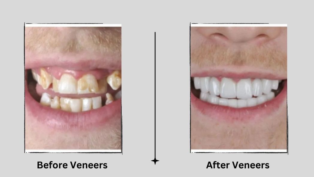 veneers